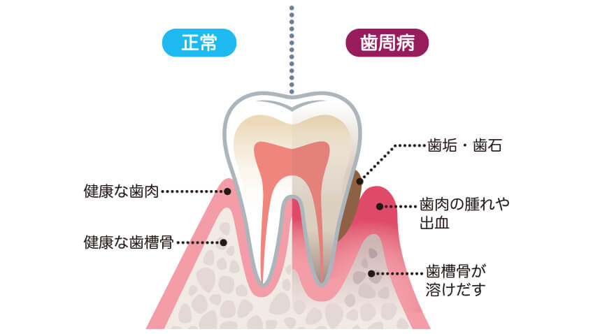 正常な歯と歯周病の歯